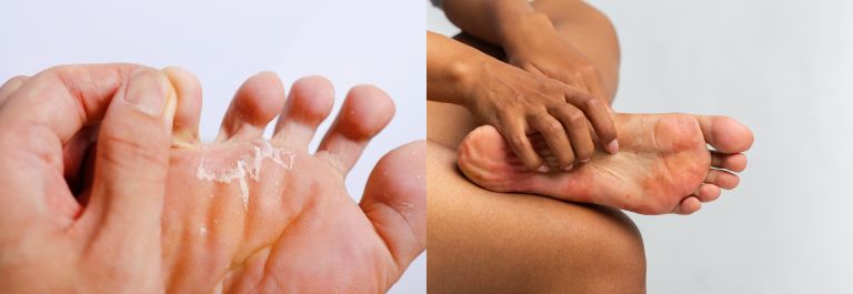 Is it Foot Eczema or Athelte's Foot?