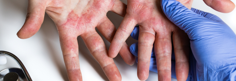 medical hand wearing latex glove expecting hand with eczema