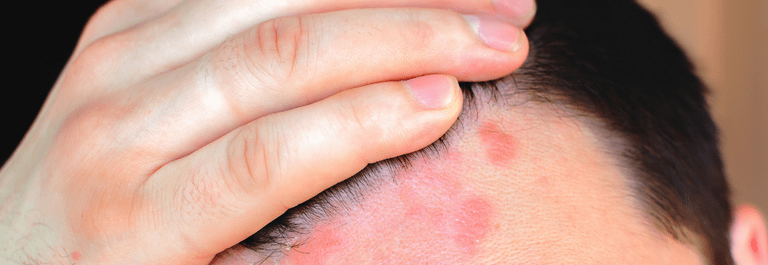 man showing eczema on forehead