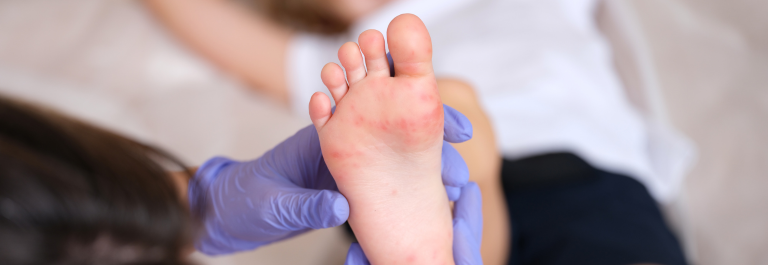 Person holding a foot with splotchy red marks on it
