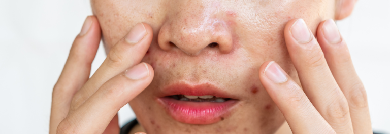 close up image of woman with oily skin holding face