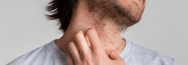 man scratching eczema on neck