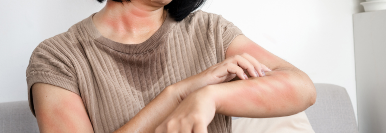 woman scratching eczema on arm