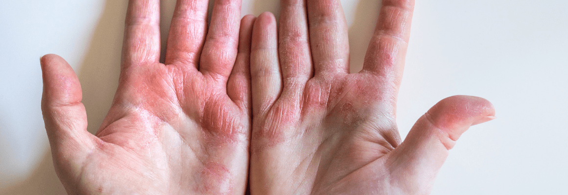 person with open palms showing contact dermatitis on hands