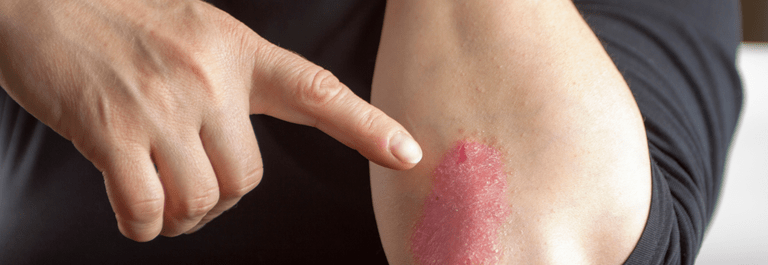 person pointing to red patch on elbow