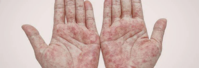 two palms side by side with red splotchy eczema