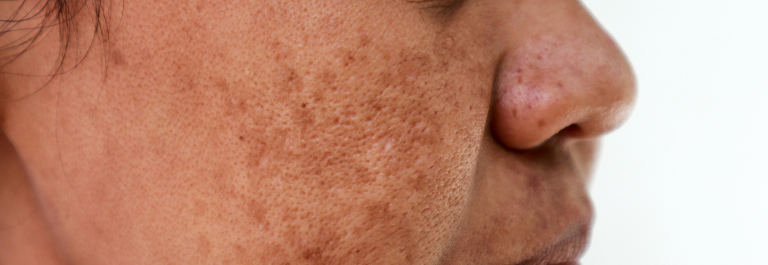 side profile of woman with dark spots on cheek
