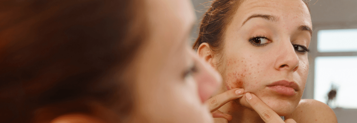 woman popping pimple in mirror