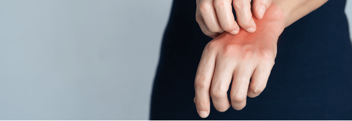 hand scratching another hand with a red rash