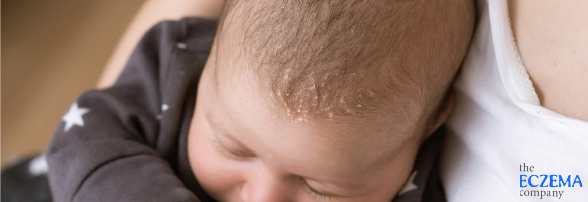 baby's head with cradle cap