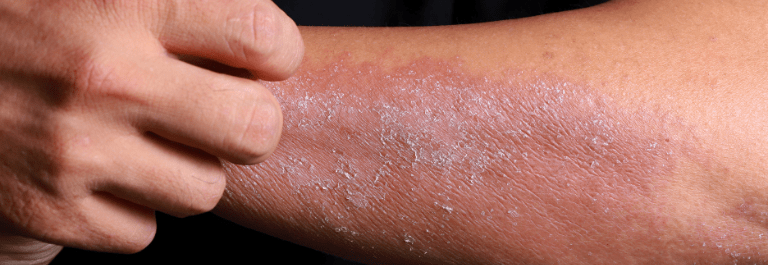person scratching dry arm