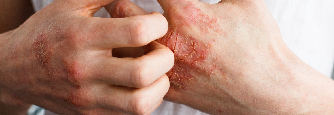 Skin Plaque Appearance, Causes, and Diagnosis