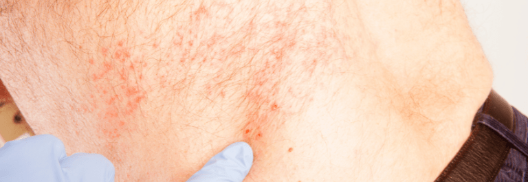 shingles on a person's body