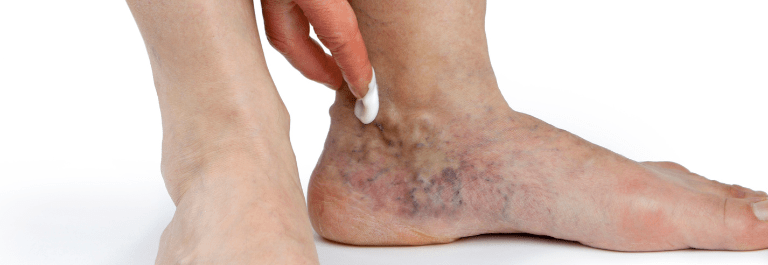 person putting cream on varicose feet