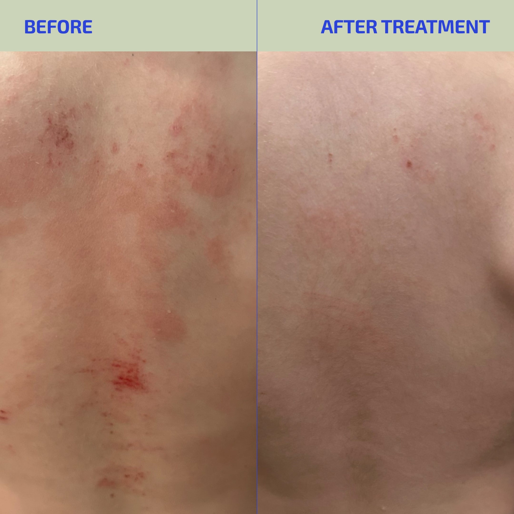 ClearSkin Synbiotic Supplement with Probiotics for Eczema-Prone Skin for Adults & Teens (Age 12Y+)