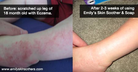 Before and after pictures with using the soap.