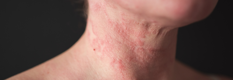 persons neck with red scaly patches of dry skin