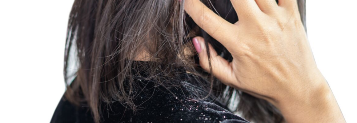 woman scratching head with dandruff