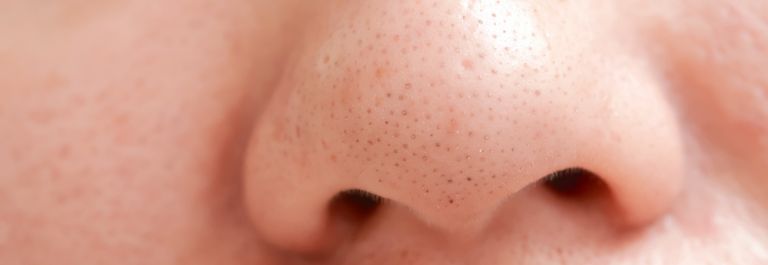 How Is Nose Seborrheic Dermatitis Treated?
