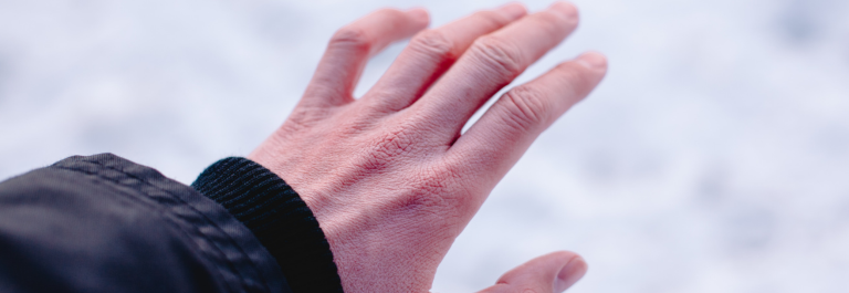 person showing their dry hand in winter 