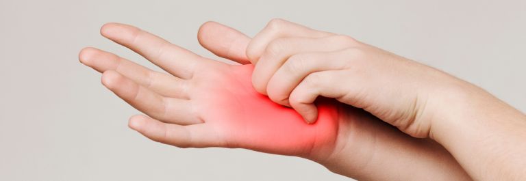 How to Naturally Heal Eczema on Palms