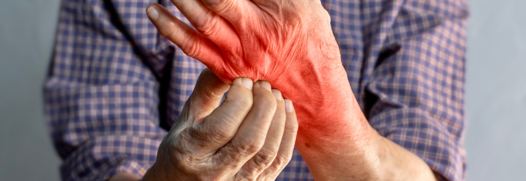 Man scratching redness on his hand from eczema secondary infection 