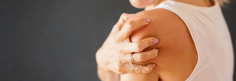 Shoulder eczema - woman scratching shoulder