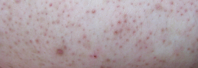 bumpy, goose-bump-like skin