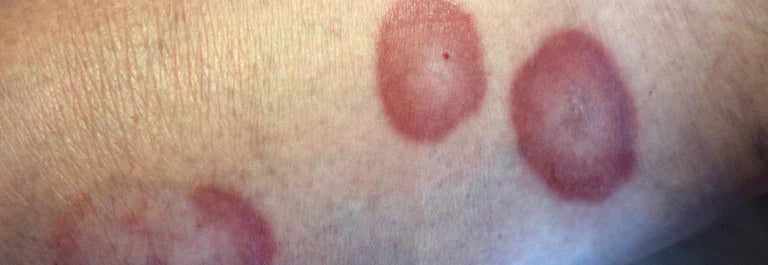 Granuloma Annulare Symptoms Causes Skin Care Support granuloma-annulare-symptoms-causes-skin-care-support