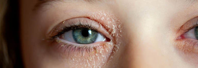 woman with blue eyes with eyelid dermatitis