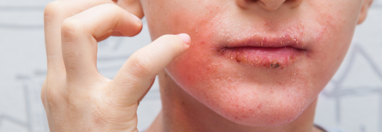 woman pointing to eczema on face