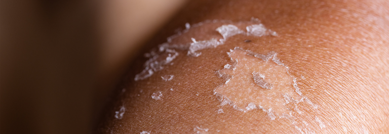 eczema peeling skin close up