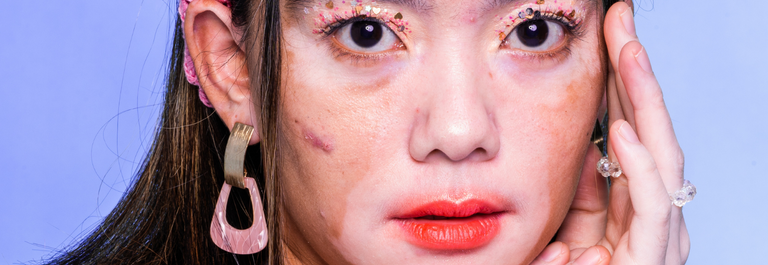 woman with white patches on face