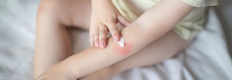 child applying cream to a red rash on the arm