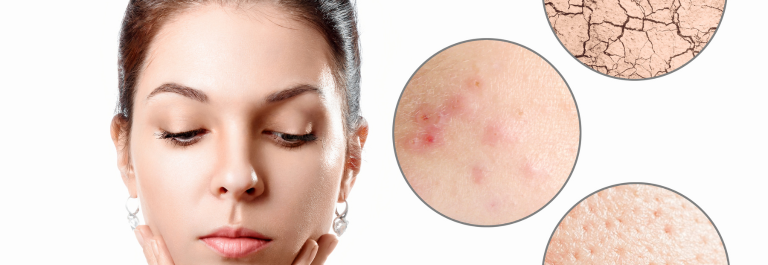 woman touching face with zoomed in circles of dry skin, acne, and red rash