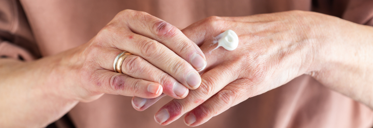 woman puttling lotion on fingers - lichenoid dermatitis
