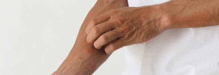 person scatching Lupus Lichenoid Dermatitis on arm