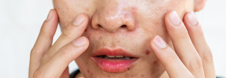 close up image of woman with oily skin holding face 