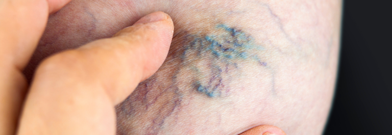 Close up shot of person touching varicose vein on leg