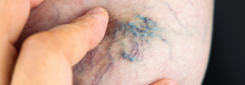What is Stasis Dermatitis?