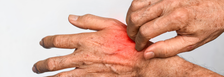 person scratching red, infected part on hand