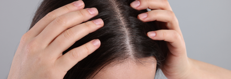 woman parting hair, showing painful scalp