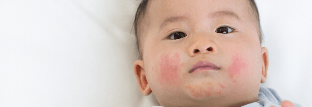 child eczema