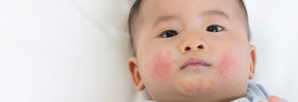 baby with acne on cheeks