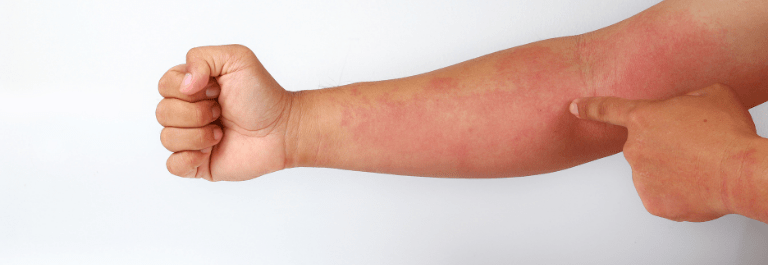 person pointing to a rash on arm