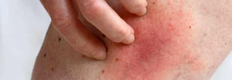 up close shot of a person scratching red rash on skin