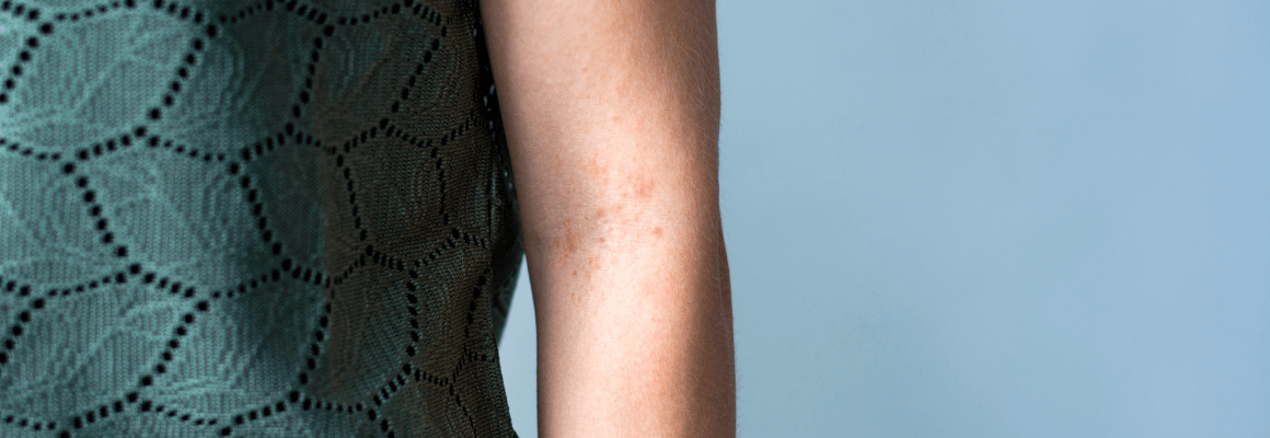 man with bumps on skin