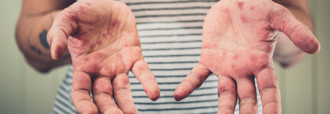 person in striped shirt displaying eczema on hands