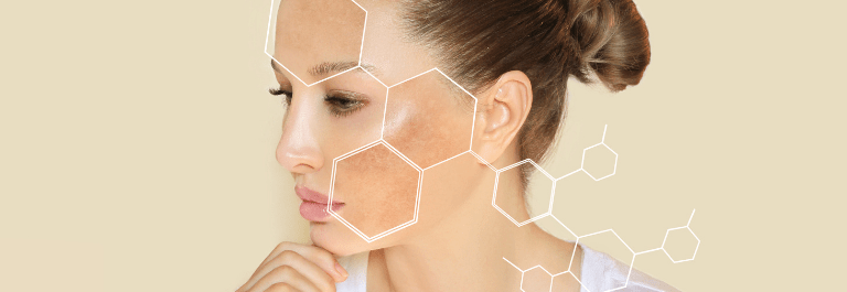 picture of woman highlighting hyperpigmentation on her cheek