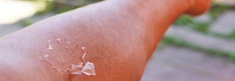 skin peeling on arm